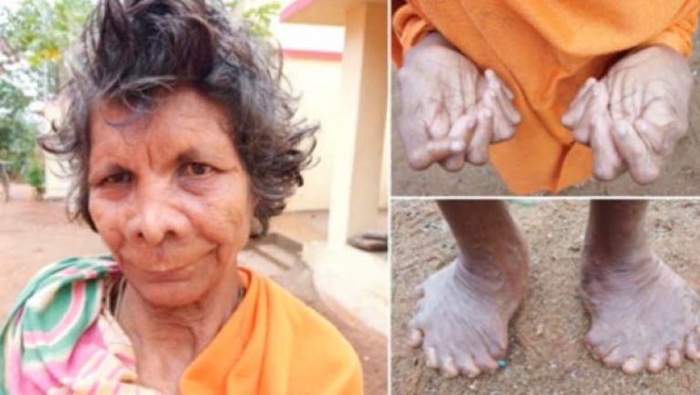 تملك 31 أصبعا تلتزم منزلها منذ 63 عاما