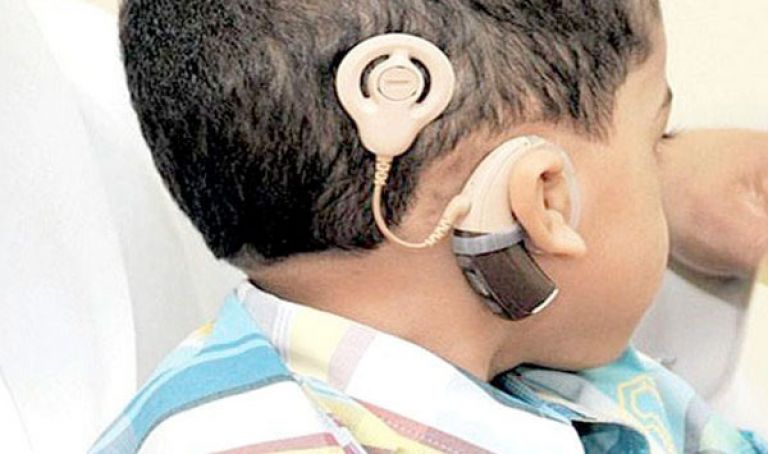 27 عملية لزرع قوقعة أذن لأطفال صمّ