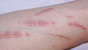 إحداث ندوب وتشويه الذات مؤشران على بوادر العنف