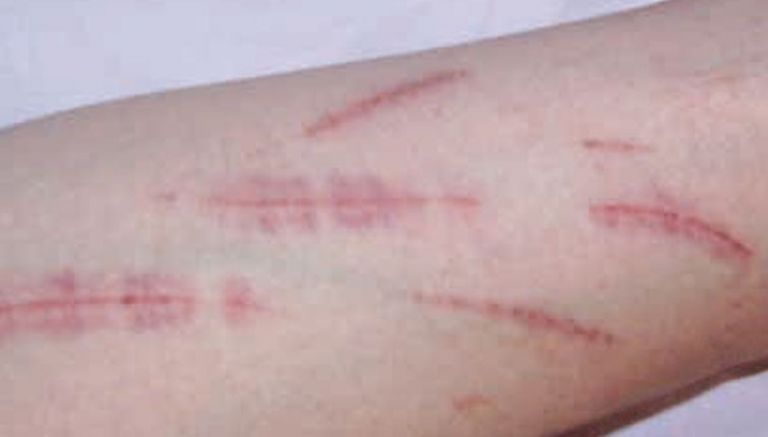 إحداث ندوب وتشويه الذات مؤشران على بوادر العنف