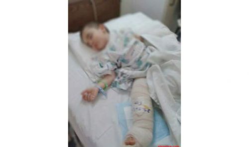 57 حالة حروق وسط الأطفال بوهران