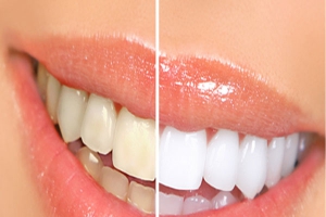 الرجال يتوافدون على مراكز تبييض الأسنان