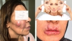 عمليات "الفيلر" و"البوتكس" بمراكز التجميل.. مجازفة خطيرة
