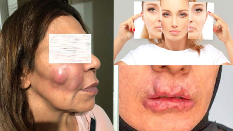 عمليات "الفيلر" و"البوتكس" بمراكز التجميل.. مجازفة خطيرة